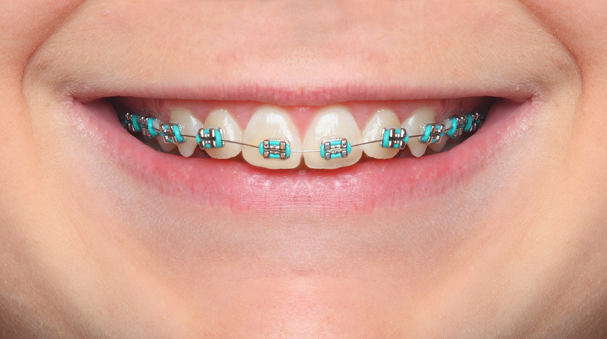 Kid Smiling Braces Closeup